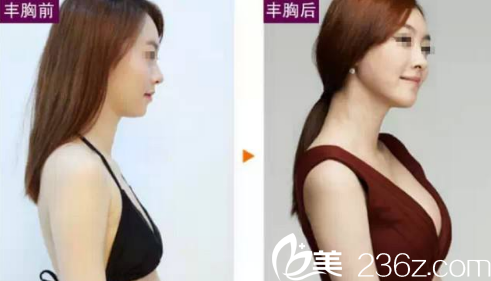 豐胸整形案例