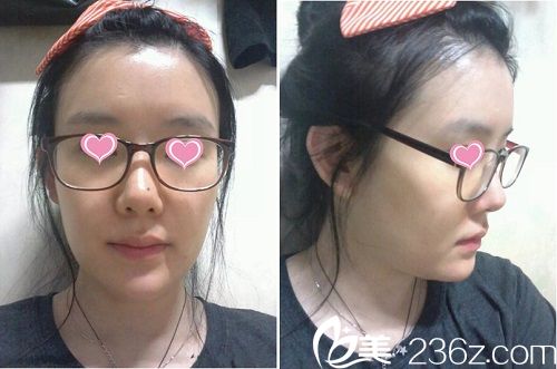 面部輪廓手術(shù)前照片 面部輪廓手術(shù)前照片