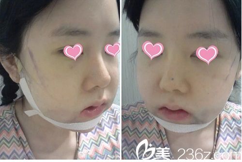 下頜角手術(shù)后3天 下頜角手術(shù)后3天