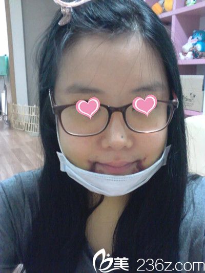 顴骨手術(shù)后10天 顴骨手術(shù)后10天