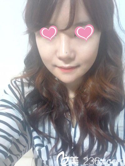 韓國星期八整形醫(yī)院面部輪廓手術(shù)案例 韓國星期八整形醫(yī)院面部輪廓手術(shù)案例