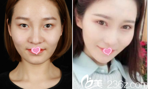 北京葉子眼綜合案例 北京葉子眼綜合案例