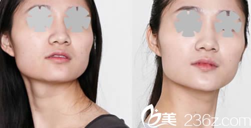 韓國江南三星整形外科面部輪廓術(shù)前照 韓國江南三星整形外科面部輪廓術(shù)前照