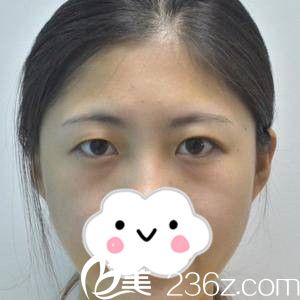 單眼皮的我 單眼皮的我