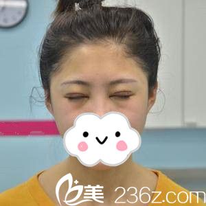 手術(shù)當(dāng)天 手術(shù)當(dāng)天