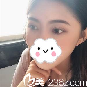 湖南雙眼皮哪家好？分享我在岳陽(yáng)你美美容醫(yī)院做雙眼皮+開(kāi)眼角20天的前后對(duì)比過(guò)程，不得不說(shuō)院長(zhǎng)的技術(shù)真的是無(wú)可挑剔