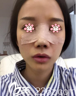 我去重慶美侖美奐醫(yī)院做完手術(shù)當(dāng)天