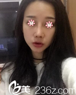 姬廣翰硅膠假體隆鼻術(shù)后一周