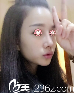 重慶美侖美奐硅膠隆鼻術(shù)后半個月