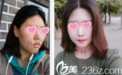 mind整形外科真人鼻綜合術(shù)前術(shù)后效果對比 mind整形外科真人鼻綜合術(shù)前術(shù)后效果對比
