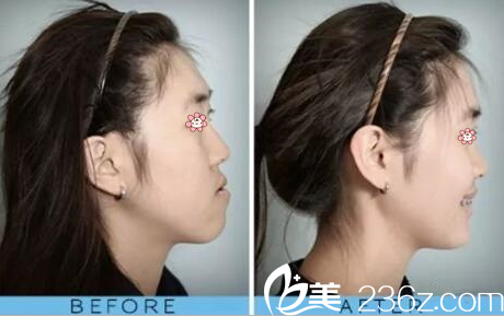 <!--<i data=20240703-sp></i>-->院長矯正突嘴案例 <!--<i data=20240703-sp></i>-->院長矯正突嘴案例