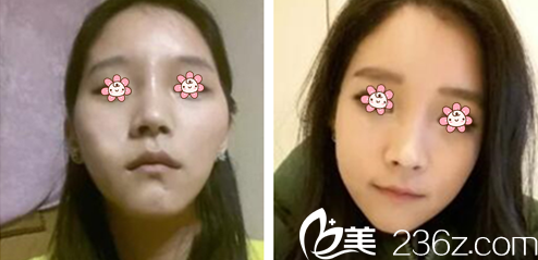 金壽信院長顴骨縮小手術(shù)案例