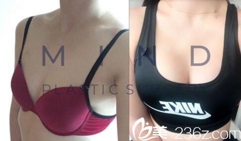 mind整形外科李永澤胸部整形真人前后對比