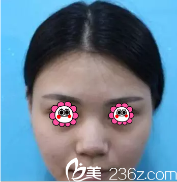 在北京葉子做假體鼻綜合前樣子 在北京葉子做假體鼻綜合前樣子