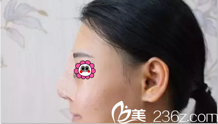 找洪春做假體鼻綜合隆鼻第3天樣子 找洪春做假體鼻綜合隆鼻第3天樣子