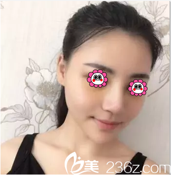 北京葉子假體鼻綜合隆鼻案例第10天效果 北京葉子假體鼻綜合隆鼻案例第10天效果