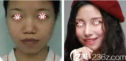 高應烈院長隆鼻案例 高應烈院長隆鼻案例