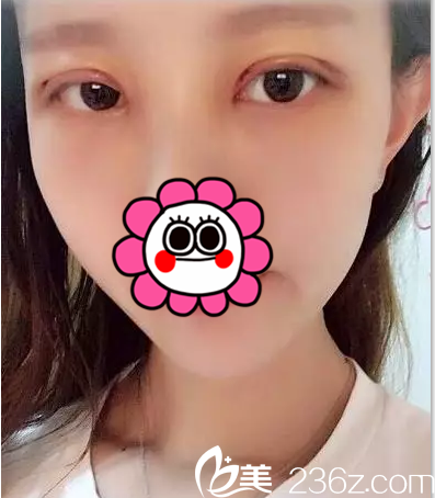 在北京葉子做雙眼皮修復第3天效果