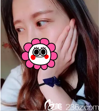 在北京葉子找魯禮新做眼修復第13天樣子