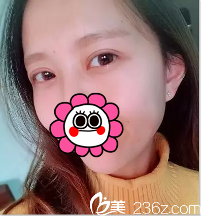 北京葉子雙眼皮修復案例