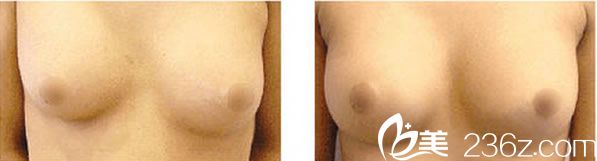 韓國(guó)美可整形假體隆胸術(shù)后效果對(duì)比圖
