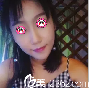 我在北京葉子做面部吸脂只因閨蜜找楊峰做水動力吸脂效果不錯