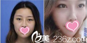 韓國VIZ整形外科醫(yī)院金鐘燦激光去眼袋真人案例 韓國VIZ整形外科醫(yī)院金鐘燦激光去眼袋真人案例