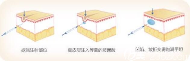 韓國VIZ整形外科醫(yī)院金錫柱玻尿酸除皺 韓國VIZ整形外科醫(yī)院金錫柱玻尿酸除皺