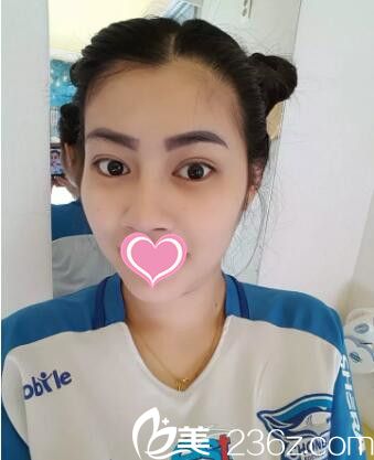 韓國(guó)做雙眼皮整形醫(yī)院哪家好？看我在韓國(guó)mind整形醫(yī)院做的雙眼皮效果怎么樣