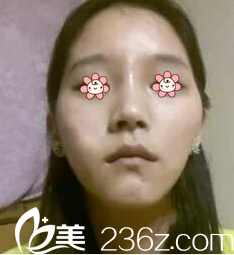 術(shù)前照 術(shù)前照