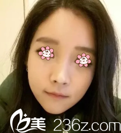 金壽信顴骨縮小加下頜角術(shù)后一個月 金壽信顴骨縮小加下頜角術(shù)后一個月