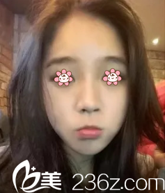 我主要是被韓國(guó)REAL整形外科金壽信的好口碑吸引過去做的顴骨縮小+下頜角手術(shù)。