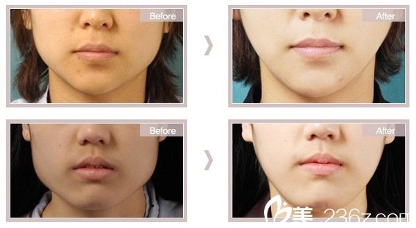 李成國(guó)院長(zhǎng)下頜角手術(shù)案例 李成國(guó)院長(zhǎng)下頜角手術(shù)案例