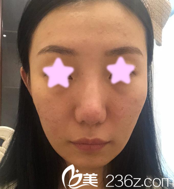 我在大同清木整形做全臉自體脂肪填充前的照片 我在大同清木整形做全臉自體脂肪填充前的照片