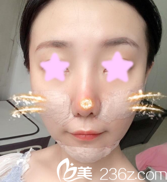 我在大同清木做面部自體脂肪填充后第3天照片 我在大同清木做面部自體脂肪填充后第3天照片