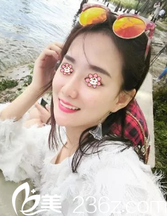 彭利濤假體隆鼻失敗修復(fù)術(shù)后半個(gè)月