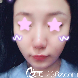 曬曬我在大同清木整形做全臉自體脂肪填充的前后效果圖，老媽說我做的價格不貴