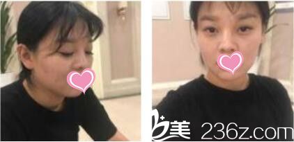 韓國(guó)VIZ整形外科醫(yī)院南成翰韓式雙眼皮+鼻綜合真人案例術(shù)前照 韓國(guó)VIZ整形外科醫(yī)院南成翰韓式雙眼皮+鼻綜合真人案例術(shù)前照