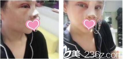 韓國(guó)VIZ整形外科醫(yī)院南成翰韓式雙眼皮+鼻綜合真人案例術(shù)后第二天 韓國(guó)VIZ整形外科醫(yī)院南成翰韓式雙眼皮+鼻綜合真人案例術(shù)后第二天