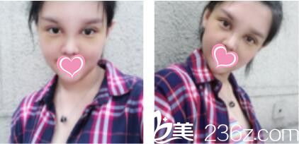 韓國(guó)VIZ整形外科醫(yī)院南成翰韓式雙眼皮+鼻綜合真人案例術(shù)后第七天 韓國(guó)VIZ整形外科醫(yī)院南成翰韓式雙眼皮+鼻綜合真人案例術(shù)后第七天