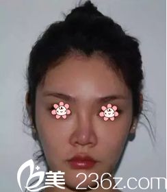 術(shù)前照 術(shù)前照