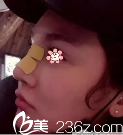 手術(shù)后一個(gè)禮拜 手術(shù)后一個(gè)禮拜