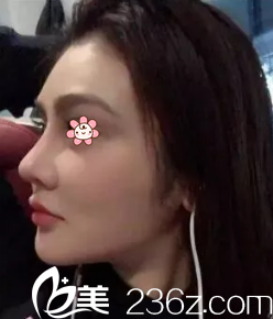 馬強(qiáng)假體隆鼻失敗修復(fù)術(shù)后19天 馬強(qiáng)假體隆鼻失敗修復(fù)術(shù)后19天