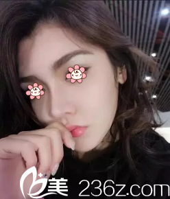 之前做的假體隆鼻鼻梁歪斜透光，現(xiàn)來了重慶賽格爾整形馬強(qiáng)這兒做鼻失敗修復(fù)。