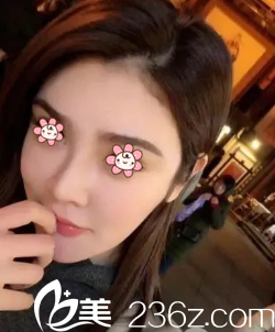 重慶賽格爾整形馬強(qiáng)鼻修復(fù)術(shù)后兩個(gè)月 重慶賽格爾整形馬強(qiáng)鼻修復(fù)術(shù)后兩個(gè)月