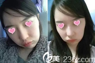 面部輪廓手術(shù)前照片 面部輪廓手術(shù)前照片