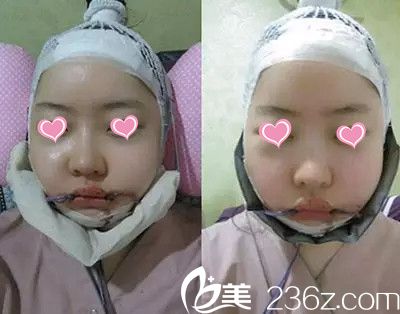 下頜角手術(shù) 下頜角手術(shù)