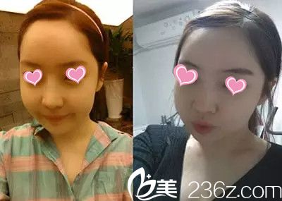 面部輪廓手術(shù)一個(gè)月后效果 面部輪廓手術(shù)一個(gè)月后效果