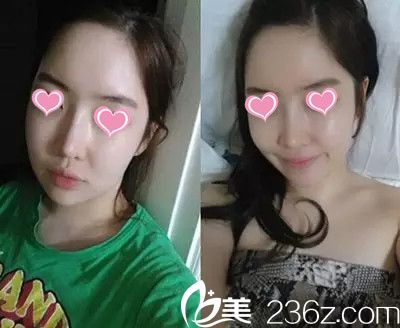 術(shù)后兩個(gè)月 術(shù)后兩個(gè)月