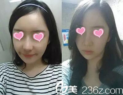 妹子鼓起勇氣去韓國美多麗娜整形醫(yī)院找李成國做了下頜角手術，恢復已經(jīng)半年了